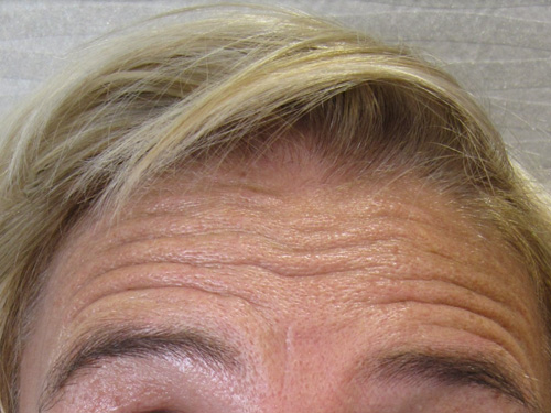 Patiente 3 - Botox avant