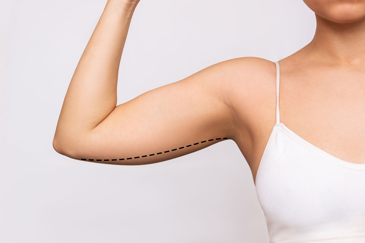 Lifting des bras