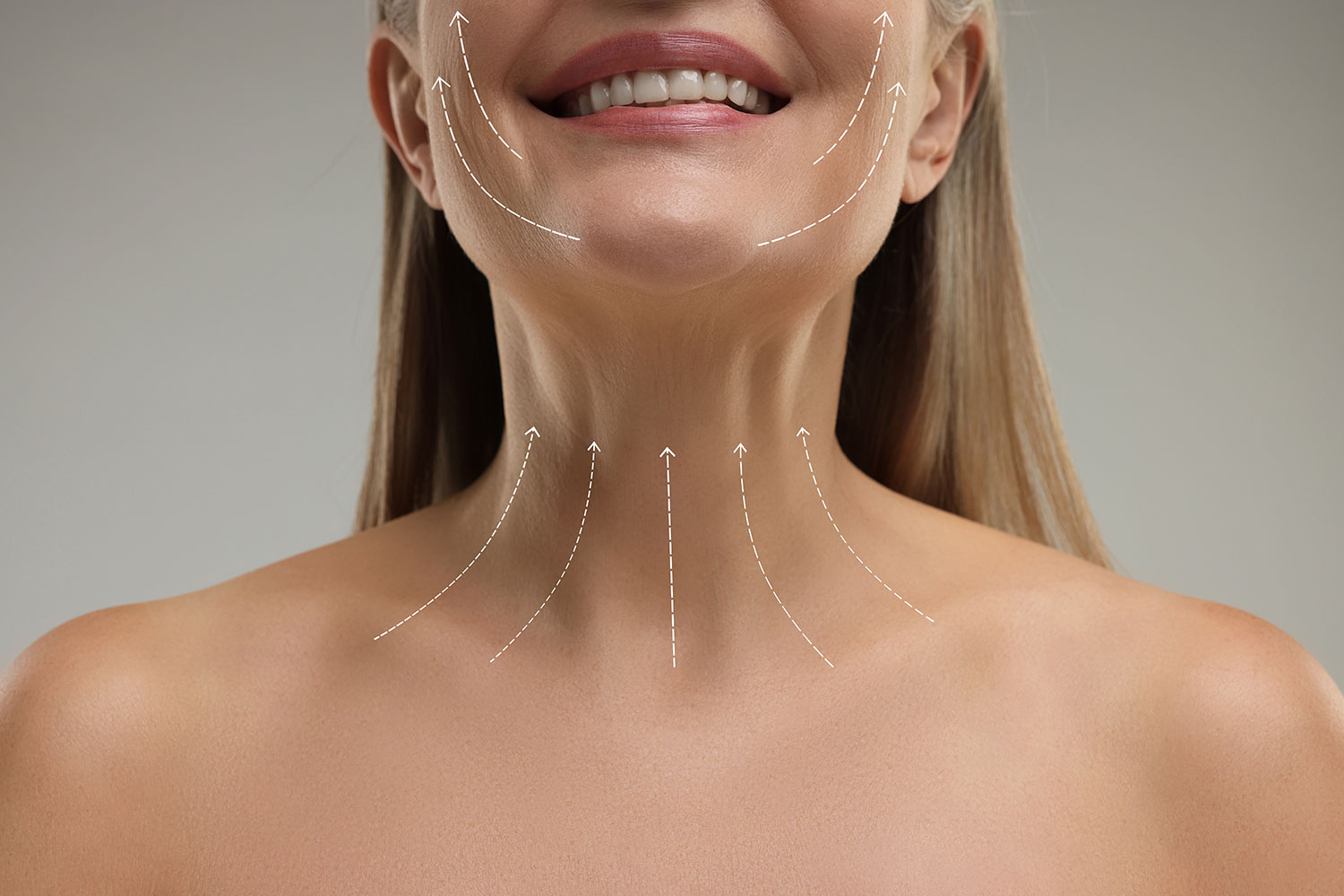 Lifting cervico-facial