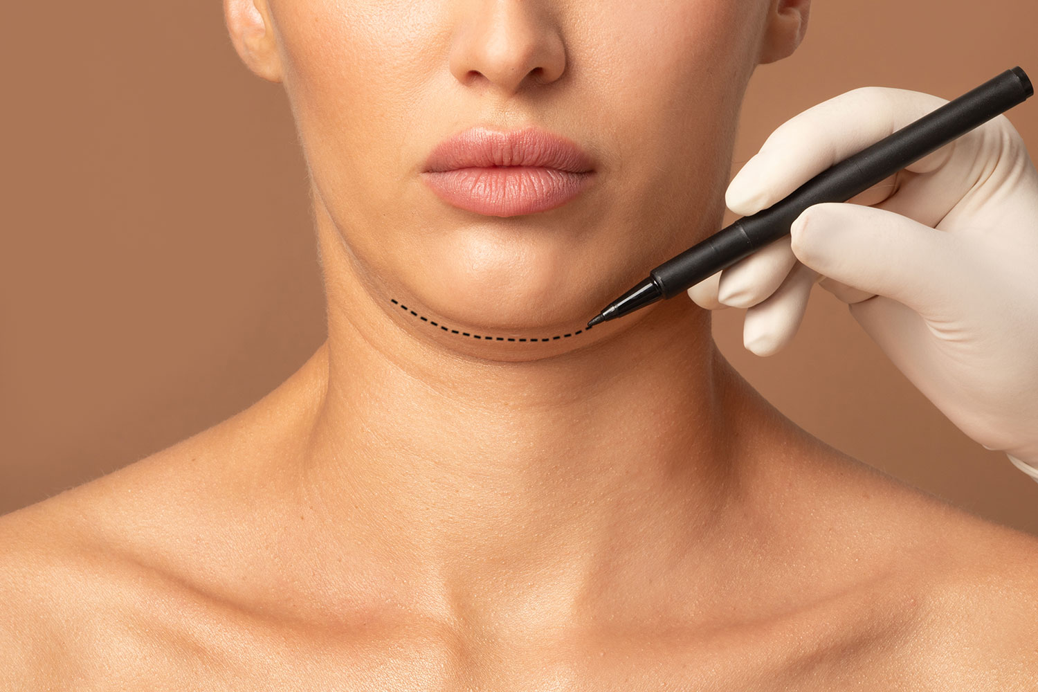 Lifting cervico-facial