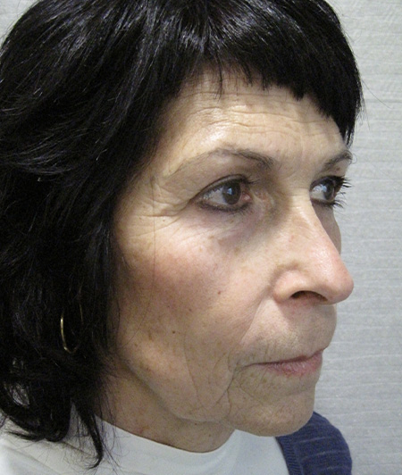 Patient 3-lifting cervico facial avant