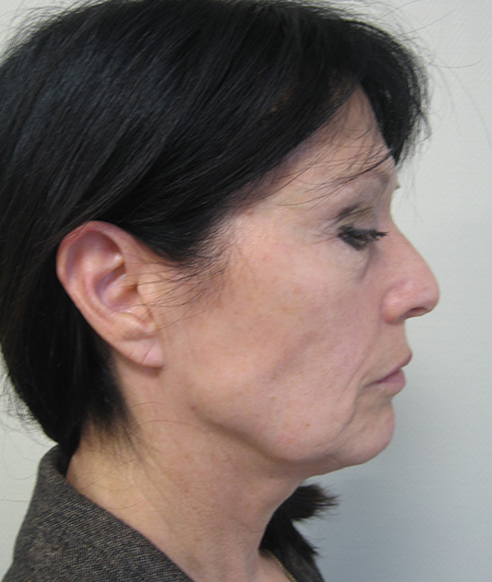 Patient 4-lifting cervico facial avant
