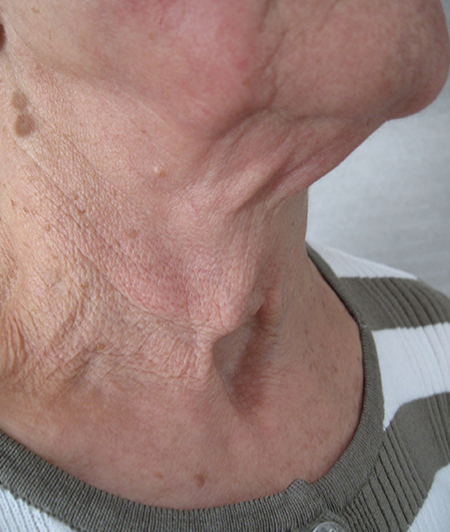 Patient 5-lifting cervico facial avant