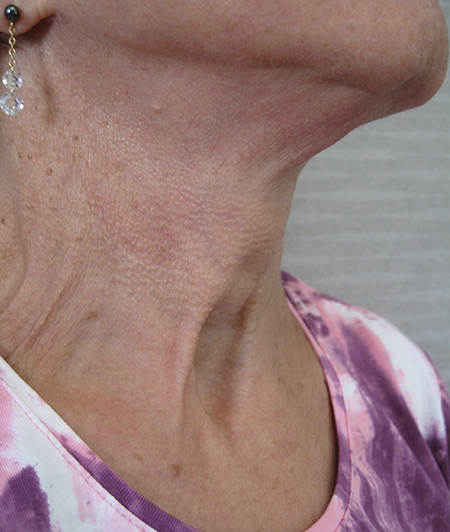 Patient 4-lifting cervico facial après