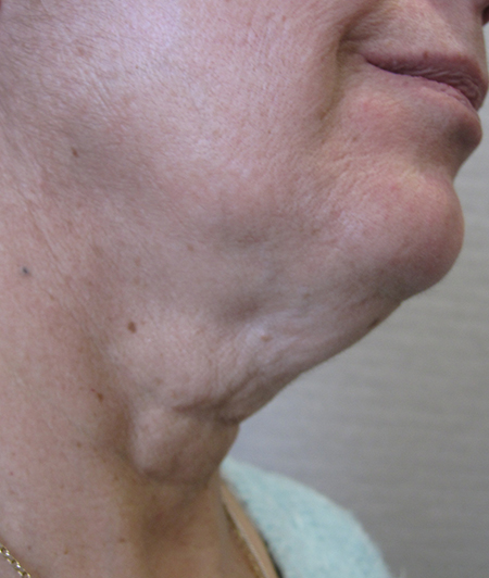 Patient 6-lifting cervico facial avant
