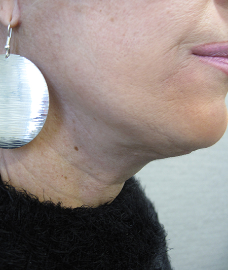 Patient 6-lifting cervico facial après