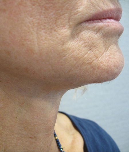 Patient 7-lifting cervico facial après