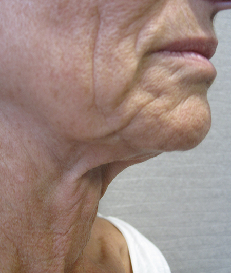 Patient 7-lifting cervico facial avant