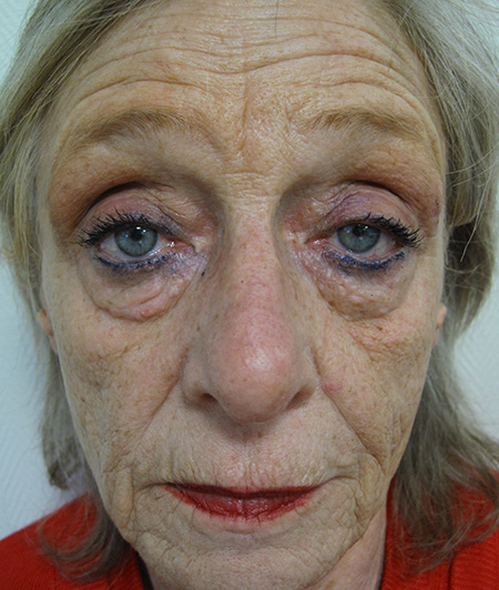 Patient 8-lifting cervico facial avant