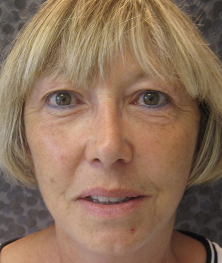 Patient 2-lifting cervico facial après