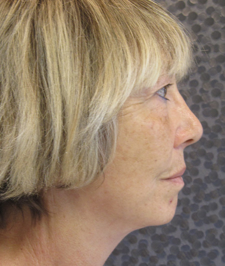 Patient 2-lifting cervico facial après