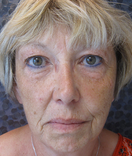 Patient 2-lifting cervico facial avant