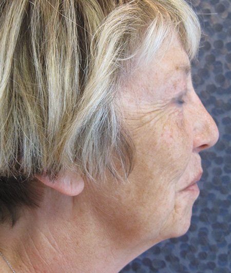Patient 2-lifting cervico facial avant