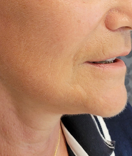 Patient 1 -lifting cervico facial après