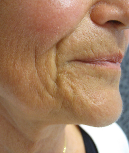 Patient 1-lifting cervico facial avant