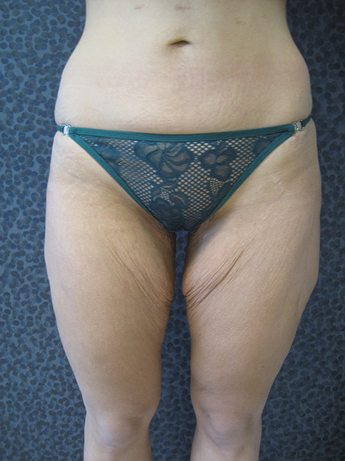 Patiente 1 - Lifting cuisse avant