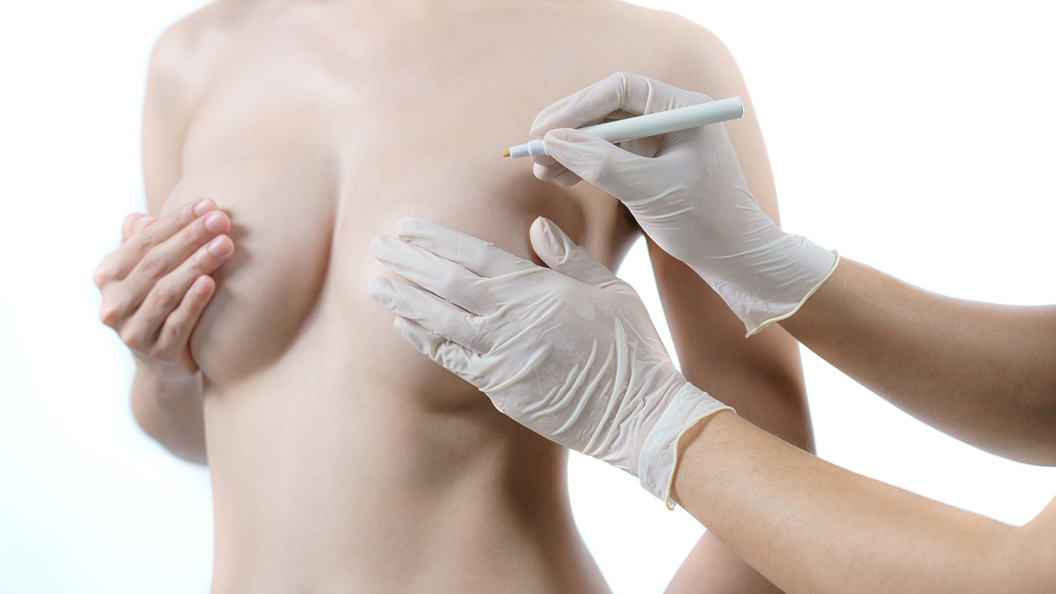 Augmentation des seins par lipomodelage