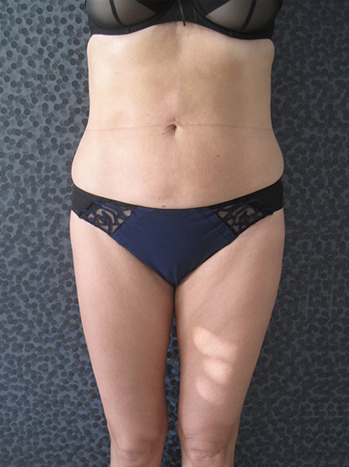 Patiente 2 - Liposuccion culotte de cheval après