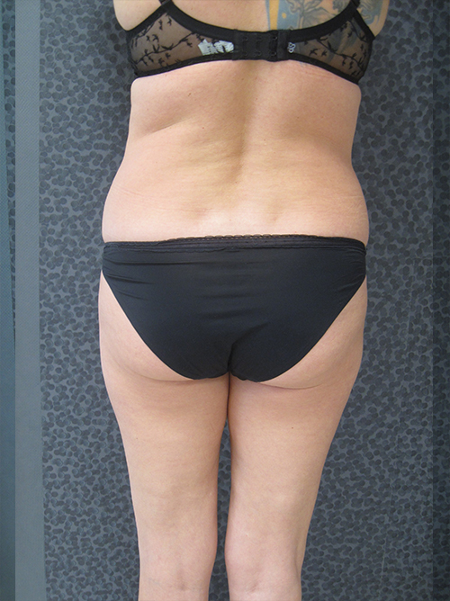 Patiente 2 - Liposuccion culotte de cheval avant