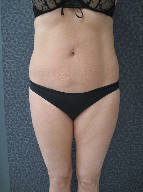 Patiente 2 - Liposuccion culotte de cheval avant