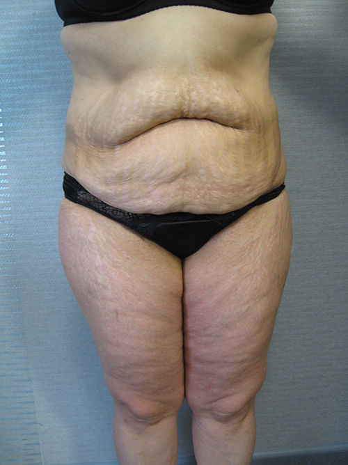 Patiente 21 - Abdominoplastie avant