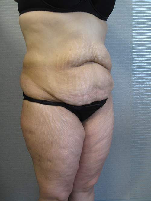 Patiente 21 - Abdominoplastie avant
