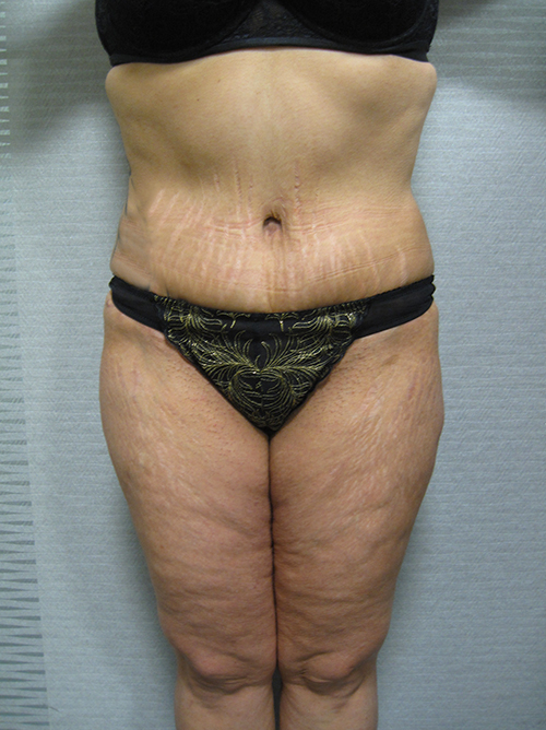 Patiente 21 - Abdominoplastie après