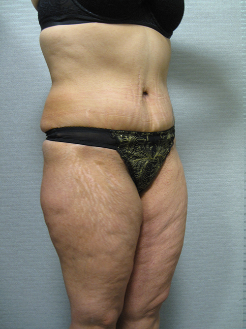 Patiente 21 - Abdominoplastie après