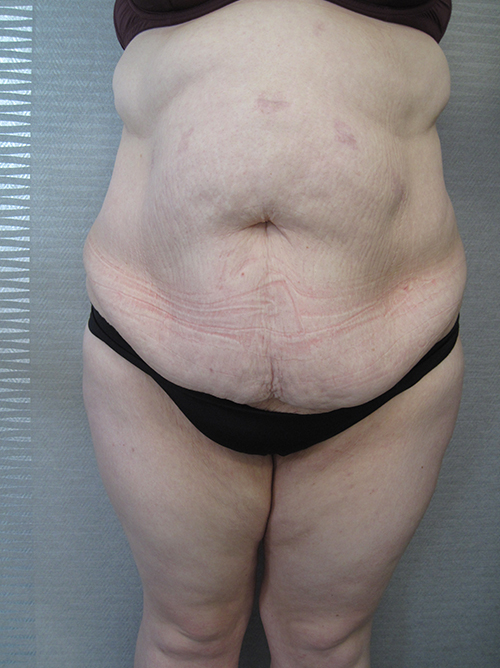 Patiente 22 - Abdominoplastie avant