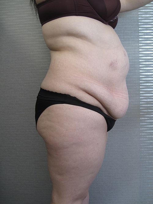 Patiente 22 - Abdominoplastie avant