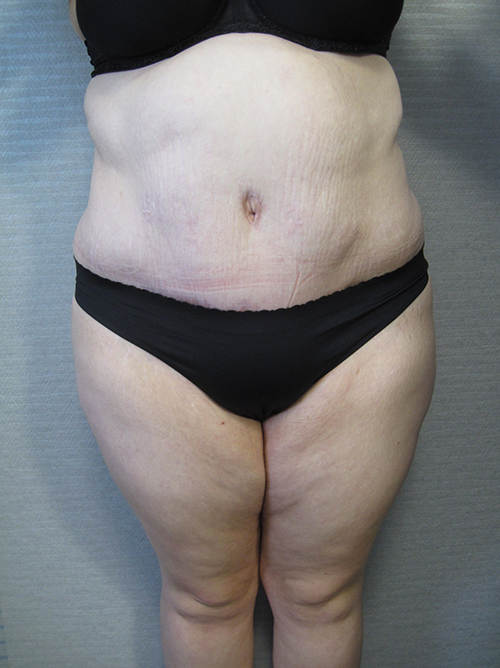 Patiente 22 - Abdominoplastie après