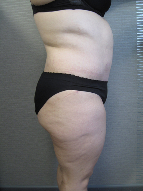 Patiente 22 - Abdominoplastie après