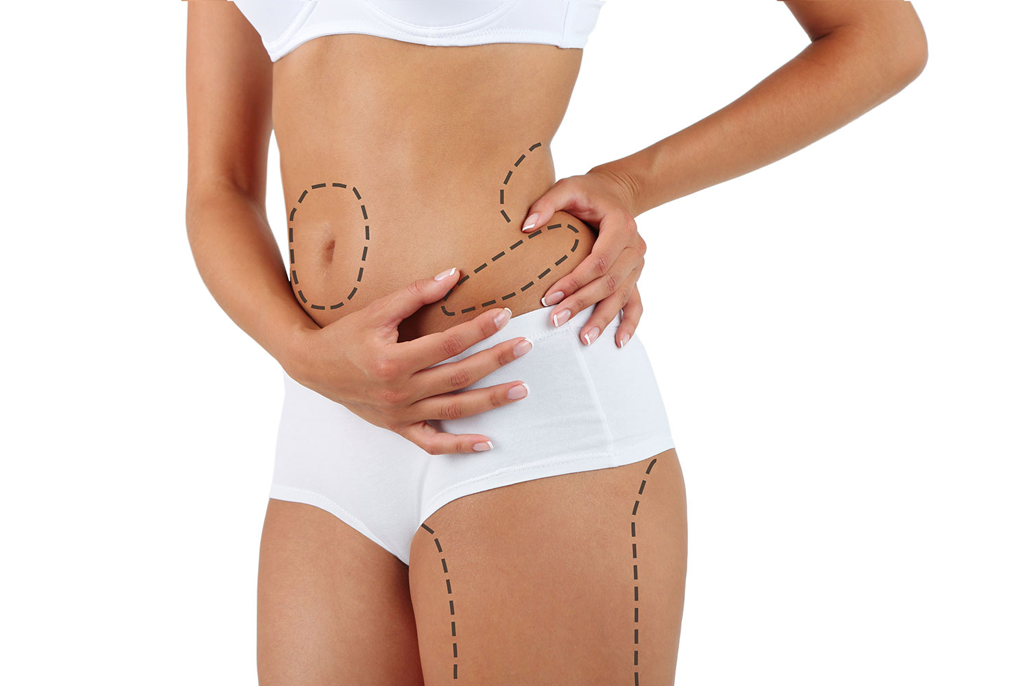 Liposuccion