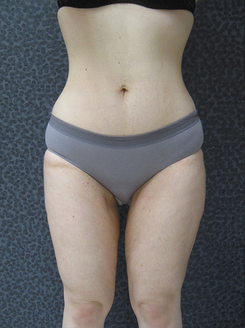 Liposuccion après