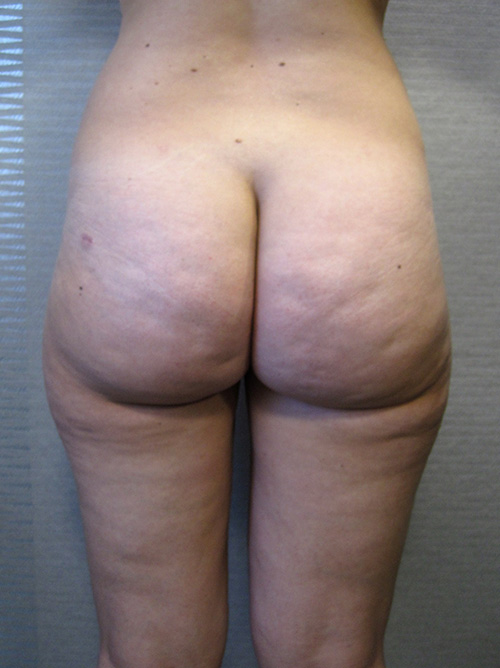 Patiente 4 - Liposuccion culotte de cheval après