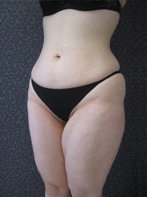 Liposuccion avant