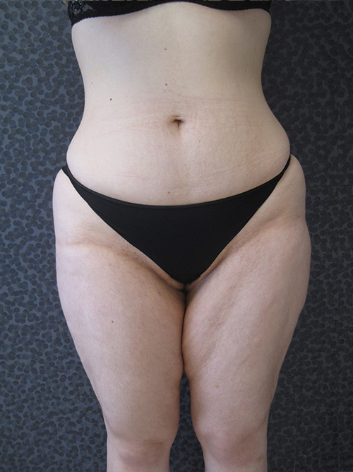 Liposuccion avant