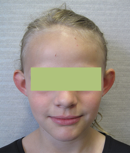 Patiente 2 - Otoplastie avant