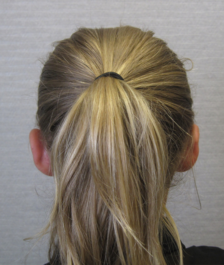 Patiente 2 - Otoplastie après