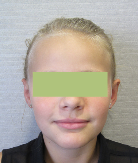 Patiente 2 - Otoplastie après