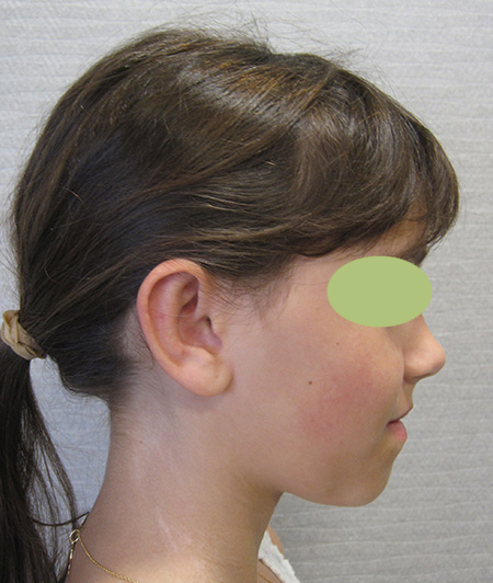 Patiente 3 - Otoplastie après