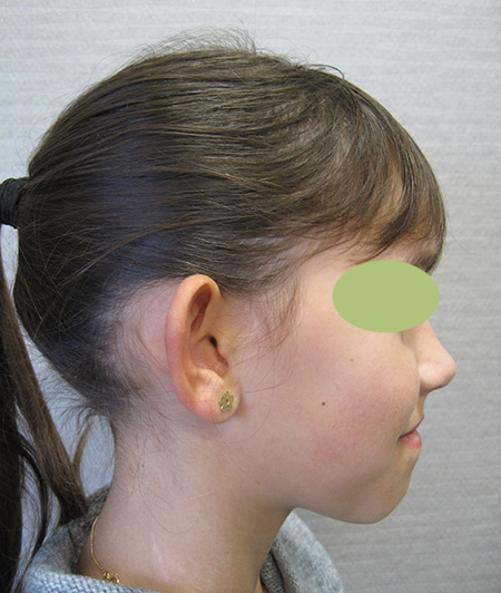Patiente 3 - Otoplastie avant