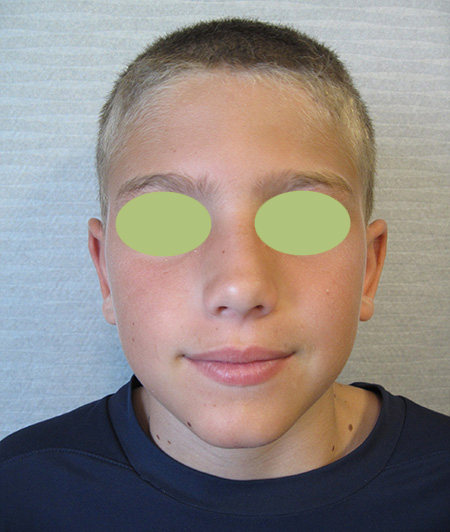 Patient 7 - Otoplastie avant