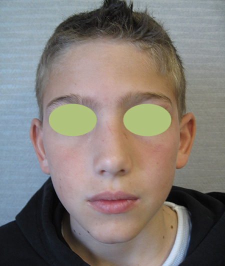 Patient 7 - Otoplastie avant