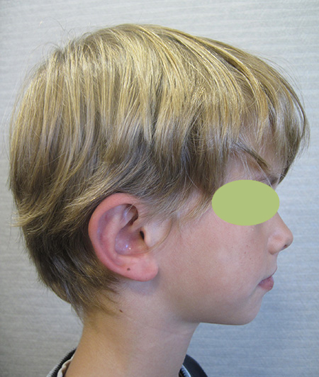Patient 8 - Otoplastie après