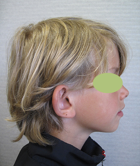 Patient 8 - Otoplastie avant