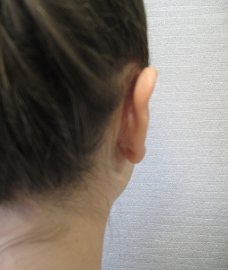 Patiente 3 - Otoplastie après