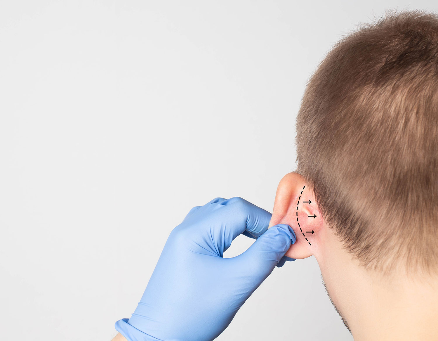 Otoplastie