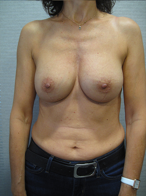 Patiente 8 - augmentation mammaire protheses après