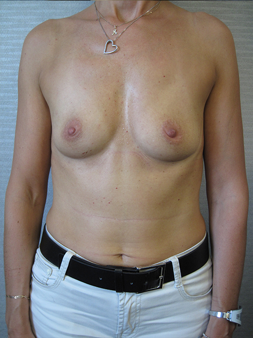 Patiente 8 - augmentation mammaire protheses avant